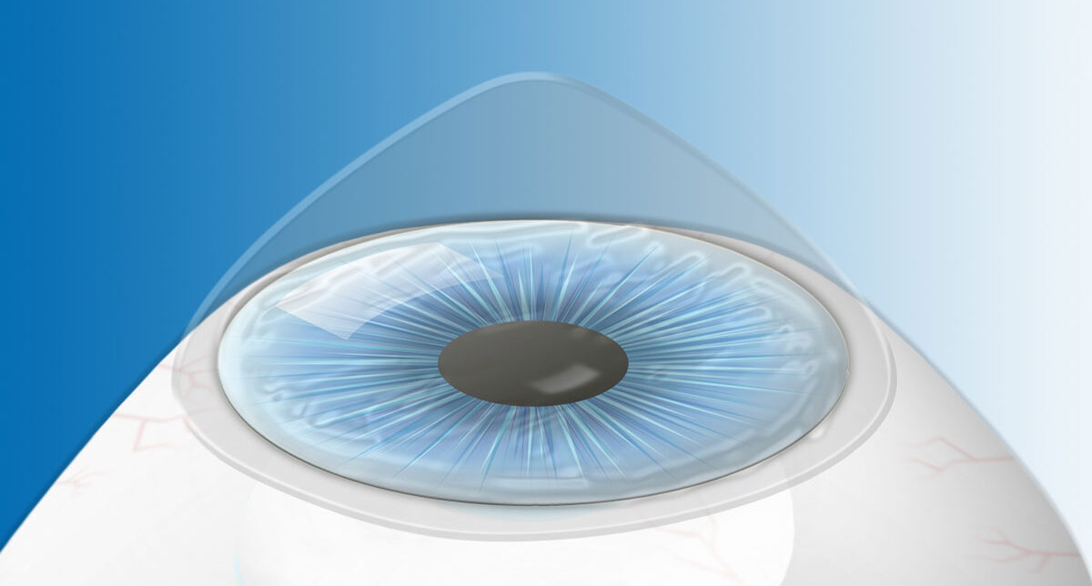 Keratokonus Hornhauterkrankungen Augenarzt Dortmund